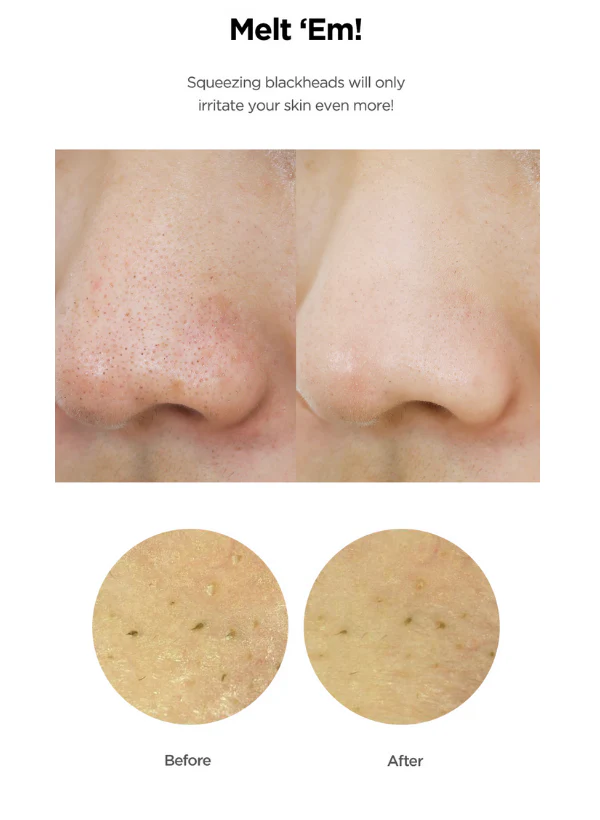 Blackhead Care 3-Step Set(Cleansing Oil + Toner + Cream) - Image 4