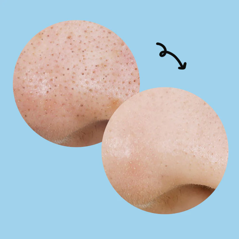 Blackhead Pure Cleansing Oil Killpad - Image 7